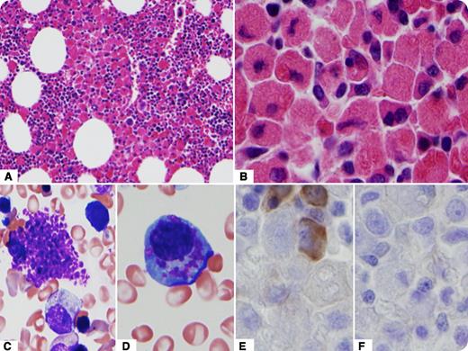 Crystal-storing histiocytosis is characterized by intra-cytoplasmic accumulation of crystallized immunoglobulins in histiocytes and is typically associated with disorders that express monoclonal immunoglobulins. A 43-year-old woman with stage IV chronic kidney disease due to renal tubular acidosis undergoing evaluation for kidney transplant was found to have a 0.2 g/dL serum IgD κ monoclonal protein on serum protein electrophoresis and immunofixation study. Bone marrow core biopsy showed numerous aggregated histiocytes with intra-cytoplasmic eosinophilic inclusions (panel A, original magnification ×20, and panel B, original magnification ×100), prominent on the aspirate smears, and present in histiocytes (panel C, original magnification ×50), as well as in the plasma cells (panel D, original magnification ×50). Immunohistochemical stains identified 5% to 8% κ monotypic plasma cells, but the intracytoplasmic crystals were negative for κ or λ immunoglobulin light chains (panels E and F, respectively, original magnification ×100). The immunoglobulin IgD heavy-chain immunostain was tried but as a result of high background staining was noncontributory. No lytic lesions were seen on imaging. The patient was diagnosed with monoclonal gammopathy of uncertain significance (MGUS) and was cleared for renal transplant. / This case illustrates prominent accumulation of crystal-storing histiocytes in the context of MGUS with low paraprotein levels.