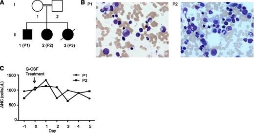 Figure 1. Clinical findings of family A. (A) Genealogic pedigree. (B) Giemsa-stained bone marrow smears of P1 and P2. (C) Response of patients P1 and P2 to rhG-CSF treatment.