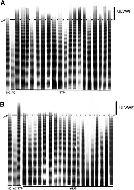 Figure 2. VWF multimeric analysis of pretreatment samples for TTP and aHUS patients. In each run shown, a normal control plasma (NC) and an abnormal control plasma (AC, obtained from a patient with type 2 von Willebrand disease) were included to verify the performance and resolution of the analysis. The area above the solid line in the figure represents the larger multimers with molecular weight higher than band #15 (indicated by an arrow) counted from the bottom of the gel. This area, indicated by an vertical line in the figure, is referred to as ULVWF. (A) Multimeric analysis from 19 acquired TTP patients. (B) Multimeric analysis from 19 aHUS patients. A sample from a TTP patient containing ULVWF is included in panel B for comparison. In a few aHUS patients, faint bands above the dotted line can be seen that represent normal variation rather than pathologically increased ULVWF multimers.
