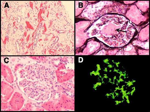 Figure 1. Histopathology of renal biopsy. (A) Hematoxylin and eosin stain demonstrating congested peritubular capillaries. (B) Congested glomerulus with segmental sclerosing lesion (black arrow). (C) Large glomerulus with mesangial hypercellularity. (D) Immunofluorescence showing mesangial IgA deposition. Panels A-C were taken on an Olympus BX50 microscope using an Olympus DP12 camera and Olympus image software (Melville, NY). The fluorescent image (panel D) was taken on an Olympus BX51 microscope with an Olympus XC50 camera. Panel A was viewed with a ×10 objective at ×10 magnification (total magnification ×100). Panels B-D were viewed with a ×40 objective at ×10 magnification (total magnification ×400).