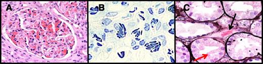 Figure 2. Acute sickle nephropathy in a renal transplant biopsy specimen. (A) Hematoxylin and eosin stain of congested and large glomerulus. (B) Toluidine blue stain demonstrating sickle-shaped red blood cells and the glomerular capillaries. (C) Silver stain highlighting a congested peritubular capillary (black arrow). Panels A-C were taken on an Olympus BX50 microscope using an Olympus DP12 camera and Olympus image software (Melville, NY). Panels A and C were viewed with a ×40 objective at ×10 magnification (total magnification ×400); panel B was viewed with a ×20 objective ×10 magnification (total magnification ×200).