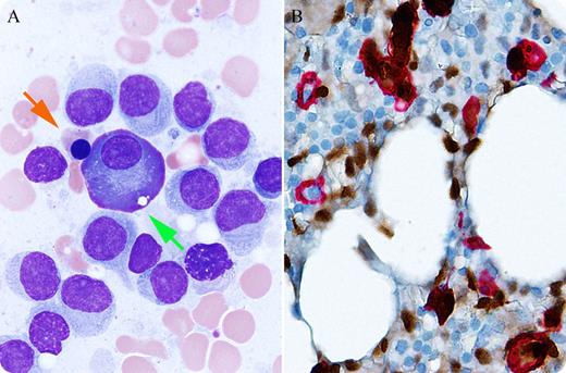 A 65-year-old man, with no previous significant complete blood count findings and no preexisting concern for hematopoietic malignancy, presented for baseline bone marrow evaluation as a potential donor for hematopoietic stem cell (HSC) transplant for his brother, a patient with mantle cell lymphoma (cyclin D1+). Marrow aspirate smear (panel A) revealed 7% myeloid precursors, 36% erythroid precursors (orange arrow), 52% lymphoid cells (un-annotated cells), and 5% plasma cells (green arrow). The vast majority of lymphocytes exhibited a moderate amount of pale cytoplasm with fluffy projections, round-to-oval bland nuclei, and inconspicuous nucleoli, indicative of hairy cells. Plasma cells were predominantly larger than normal, some exhibiting prominent nucleoli. The normocellular marrow biopsy showed extensive interstitial lymphoid infiltrate morphologically and immunophenotypically diagnostic of hairy cell leukemia (positive for pan–B-cell markers, CD25, Annexin A1, and TRAP). There was also an increase in atypical plasma cells (10%-20%) with focal clustering/sheeting, most consistent with asymptomatic plasma cell myeloma because close monitoring detected no serum paraprotein or signs of end-organ damage. Dual immunohistochemical staining with cyclin D1 (brown) and CD138 (red) (panel B) demonstrated that both hairy cell leukemia (cyclin D1+/CD138–) and atypical plasma cells (cyclin D1+/CD138+) were positive for cyclin D1, with few normal plasma cells (cyclin D1–/CD138+). / In this potential donor for hematopoietic stem cell transplant, routine bone marrow biopsy evaluation revealed findings indicative of a presence of synchronous hairy cell leukemia and plasma cell myeloma, a rare observation.