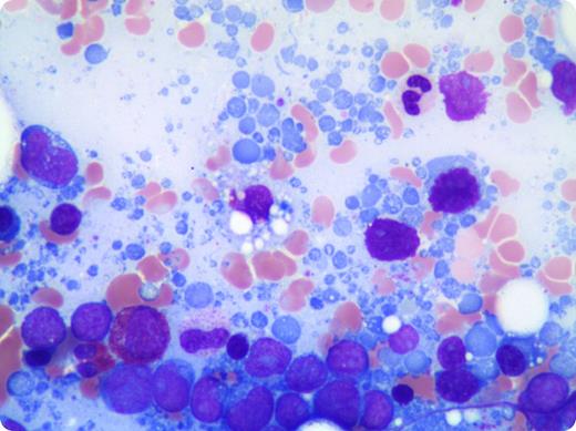 A 79-year-old woman presented with hypercalcemia and a mediastinal mass identified by computed tomography scan. Further imaging revealed several intracranial lesions that were not intraparenchymal, as well as a large periaortic mass with diffuse abdominal lymphadenopathy. A biopsy of the mediastinal mass yielded a diagnosis of B-cell lymphoma, unclassifiable, with features intermediate between diffuse large B-cell lymphoma and Burkitt lymphoma. A staging bone marrow examination was performed and revealed extensive involvement by an aggressive appearing large B-cell lymphoma. A striking number of lymphoglandular bodies were present in the bone marrow aspirate smears. / Lymphoglandular bodies are cytoplasmic fragments, commonly observed and reported in fine-needle aspiration or cytology preparations of lymphoid tissue, often in association with lymphoid malignancies. They have been less frequently reported in bone marrow aspirate smears. Although not a specific finding, lymphoglandular bodies have been shown to be present in higher numbers in bone marrows involved by B-cell lymphoid malignancies compared with T-cell lymphoid malignancies and myeloid leukemias. Their pale, lightly basophilic color with smooth borders, occasional blebs, and lack of granulation allow them to be distinguished from platelets.