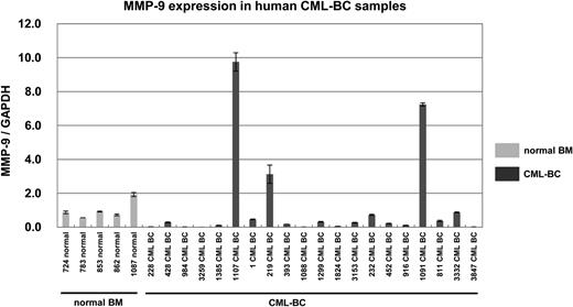 Figure 3. MMP-9 expression was elevated in 3 of 20 CML-BC patients. Real-time RT-PCR for MMP-9 in samples from healthy subjects (light shaded bar) or patients with CML-BC (dark shaded bar). Expression levels were normalized by GAPDH mRNA. RNA from normal BM cells served as a control (mean of 5 RNA levels of normal BM was defined as 1). MMP-9 mRNA levels exceeded 3.0 in 3 of 20 samples from CML-BC patients.