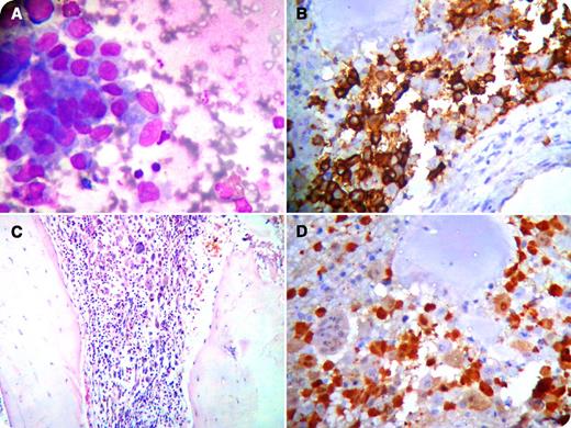 A 6-year-old female presented with complaints of thirst, polyuria, weight loss, and fainting spells lasting more than 1 month. Neck swelling and fever had occurred for a week. On examination, the child was underweight and afebrile, with mild pallor and no icterus. An ulcerating lesion on the right side of the forehead and a few reddish papules 3-4 mm in diameter on the trunk were present. Bilateral inguinal and cervical nodes were enlarged. Nodes were nontender and discrete. Hepatosplenomegaly was absent. Investigations revealed hemoglobin 9.3 g/dL, white blood cell count 19.9 ± 103/µL, polymorphs 64%, lymphocytes 20%, eosinophils 10%, monocytes 6%, platelets 278 × 103/µL, alanine aminotransferase 159 U/L, aspartate aminotransferase 253 U/L, and normal renal function. Serum and urine osmolality were below normal range. Multiple lytic lesions in her skull radiograph and a nonvisualized posterior pituitary bright spot on magnetic resonance imaging suggested a likely diagnosis of Langerhans cell histiocytosis. / A bone marrow aspirate revealed clusters of oval cells with grooved nuclei (panel A). Bone marrow biopsy showed mild hypocellularity and patchy histiocytic infiltrates (panel C). The histiocytic cells were positive for CD1a (panel B) and S100 (panel D), confirming the diagnosis of disseminated Langerhans cell histiocytosis. The patient received vinblastine and prednisolone for 6 weeks and continues to receive desmopressin.