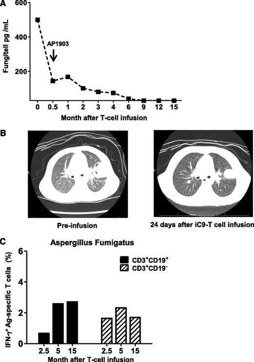 Figure 5. Anti-Aspergillus fumigatus immune-response after iC9-T-cell infusion and administration of AP1903. Patient 1 entered haplo-HSCT with pulmonary Aspergillosis. (A) Fungitell levels at different times after infusion of iC9-T cells. Arrow indicates the administration of AP1903 to control acute GvHD. (B) Computed tomography scan of chest showing left upper lung lobe lesion from Aspergillus fumigatus, before iC9-T cell infusion and 24 days after infusion. Images show a decrease in size of the largest nodule within the left upper lobe (left) at 24 days after iC9-T-cell infusion with a loss of cavitary appearance (right). (C) Detection of Aspergillus fumigatus specific T-cells by intracellular IFN-γ release from both CD3+CD19+ and CD3+CD19− T cells in samples collected at different times after AP1903 administration.