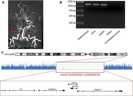 Figure 1. The radiological and genetic diagnosis of Xq28 linked moyamoya in hemophilia A patient. (A) MRI angiography, the arrows show truncation of the internal carotid arteries. (B) Long-range PCR products in 4 members of the family. (C) NGS trace (the location shown on chromosome ideogram) below genes located within the region, which corresponds to the long-range PCR-confirmed Xq28 deletion in a SHAM patient (indicated with red box).