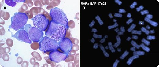 A 66-year-old man with a history of hepatitis C virus and liver transplantation presented to the emergency department for shortness of breath. He had received weekly filgrastim for chronic neutropenia, and immediately before admission he had received 3 days of filgrastim and 1 day of pegfilgrastim. A hemogram showed a white blood cell count of 4.54 K/μL with 23% blastic cells. Emergent bone marrow specimen revealed 50% blasts and 43% promyelocytes with Auer rods (panel A). Flow cytometry demonstrated a predominant population expressing myeloid antigens, CD38, CD117, and dim CD7, but not HLA-DR or CD34. These features suggested acute promyelocytic leukemia (APL) and treatment with all-trans-retinoic acid (ATRA) was initiated. Subsequent fluorescence in situ hybridization testing for promyelocytic leukemia (PML)/retinoic acid receptor alpha (RARα) with dual-fusion and RARα break-apart probes was negative (panel B). Molecular testing for PML/RARα messenger RNA by reverse-transcriptase polymerase chain reaction was also negative, but FLT3-ITD was positive. Despite morphologic and immunophenotypic evidence for APL, confirmatory cytogenetic and molecular tests were negative; therefore, acute myeloid leukemia–not otherwise specified was the final diagnosis. / Marrow specimens obtained after exposure to granulocyte colony-stimulating factor preparations should be interpreted cautiously because the features of AML may be altered, allowing confounding overlap with APL. This distinction must be made to avoid unnecessary risk of toxicity—although it is low—as a result of ATRA use in non-APL patients.