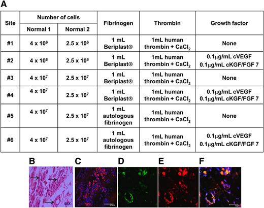 Figure 2. Evidence of neovascularization after implanting autologous BOECs mixed in various fibrin-based matricies into the omentum. (A) Autologous BOECs isolated from 2 normal dogs (Normal 1 and Normal 2) were implanted into 6 individual sites (sites #1 to #6) in the greater omentum in each of the dogs. Various numbers of BOECs (2.5 × 106 to 4 × 107) were implanted in each site. The fibrin-based matrix consisted of fibrinogen (either autologous or obtained from the Beriplast kit) and human thrombin from the Beriplast kit. Growth factors were included with the cells implanted into sites #2, #4, and #6. (B) Normal dog #2 was biopsied 3 months after implanting the autologous BOECs. Hematoxylin and eosin staining of a representative sample isolated from site #6. Arrows indicate areas of neovascularization. (C) Confocal microscopic analysis of a biopsy sample taken from site #6 and immunostained for FVIII (red). (D-F) Representative images of one of the structures appearing to be a small blood vessel immunostained with antibodies for FVIII (red), vWF (green), and DAPI (blue).