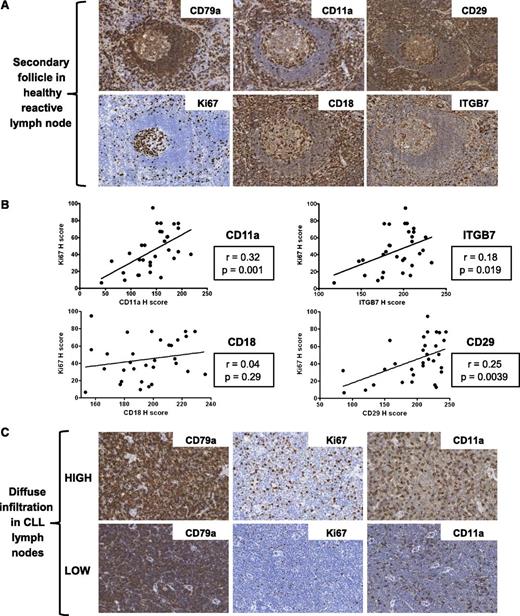 Figure 3. Increased integrin expression correlates with increased numbers of proliferating B cells in healthy and CLL LNs. (A) Representative images of a secondary follicle in a healthy reactive LN. Proliferating germinal center B cells exhibit higher expression of CD11a, CD18, CD29, and ITGB7 than mantle zone B cells. (B) Across LN biopsies from all cytogenetic groups, the presence of higher numbers of proliferating cells correlated with increased expression of CD11a, CD29, and ITGB7, but not CD18. (C) Representative images of CLL LN biopsies without proliferation centers. Biopsies with high numbers of Ki67+ proliferating cells have increased expression of CD11a compared with biopsies with low numbers of Ki67+ proliferating cells. The increased expression of CD11a in biopsies with high numbers of Ki67+ proliferating cells was due to increased staining of the CD79a+ cells.