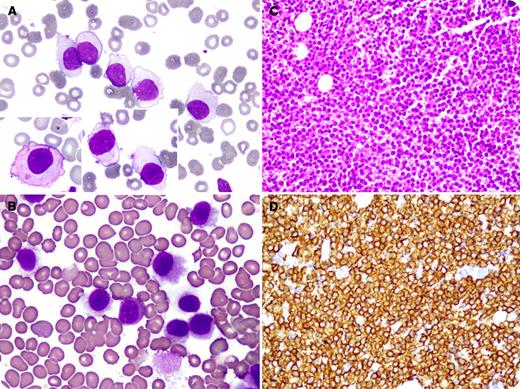 A 49-year-old man presented with a history of weakness lasting one year. Physical findings included pallor and a 12-cm palpable spleen. Complete blood counts reported hemoglobin 8.0 g/L, hematocrit 26.6, mean corpuscular volume 92 fL, mean corpuscular hemoglobin 27.8 pg, white blood cells 11 × 109/L, absolute lymphocyte count 7.7 × 109/L, and platelets 59 × 109/L. Peripheral blood film displayed normochromic normocytic red cells, low platelets, and numerous atypical lymphocytes having tadpolelike shapes, abundant agranular cytoplasm with blebs, round nuclei, and indistinct nucleoli (panel A). Bone marrow aspirate was dilute, showing similar lymphocytes (panel B). Bone marrow biopsy showed a completely effaced architecture with monotonous infiltrate of spaced out lymphoid cells (panel C), strongly expressing CD20 (panel D) but negative for CD 138. Flow cytometric immunophenotyping showed bright reactivity to CD19, CD20, CD22, cCD79a, HLA-DR, CD45, CD11c, CD25, and CD103 with IgM-, κ-, and λ- light-chain restriction, confirming a diagnosis of hairy cell leukemia (HCL). / HCL is a rare, indolent B-cell neoplasm with lymphoid cells having characteristic hairy projections. However, nonclassic hairy cells are not uncommon. The cells illustrated in panel A are confusing and could reflect HCL, splenic marginal zone lymphoma, atypical chronic lymphocytic leukemia, prolymphocytic leukemia, or plasma cell leukemia.