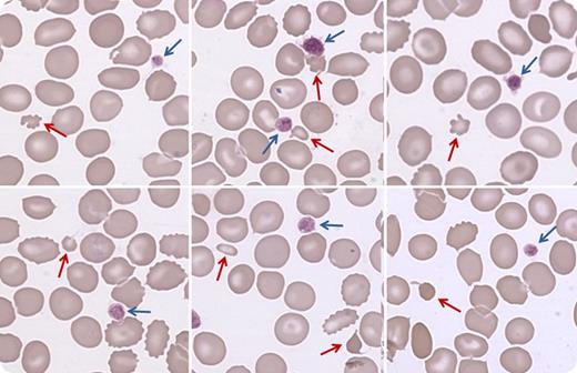 A 7-year-old girl affected by β-thalassemia minor was referred to us for the presence of wandering platelet counts. Platelet count was normal at the age of 2. At the age of 5, she presented with easy bruising and 30 × 109 platelets per L. Bleeding tendency disappeared spontaneously in a few weeks, and platelet count increased to 80 × 109/L. Subsequently, platelet counts measured in different laboratories fluctuated unpredictably from 80 to 250 × 109/L. EDTA-dependent pseudothrombocytopenia was excluded, and platelet counting by microscopy in a Neubauer chamber and by an optical cell counter revealed that the patient had 85 × 109 platelets per L. At variance, an impedentiometric counter gave 168 × 109 platelets per L in the same blood sample. Examination of blood films showed the presence of a few very small erythrocytes or fragments of erythrocytes (red arrows) with a size similar to that of platelets (blue arrows), which were a little larger than normal. Microerythrocytes were 1.7% of red cells (absolute count 96 × 109/L). / We concluded that most small red cells had been counted as platelets by the impedentiometric counter. After excluding secondary thrombocytopenias, we diagnosed a mild immune thrombocytopenia that, with some cell counters, was masked by the presence of very small erythrocytes.