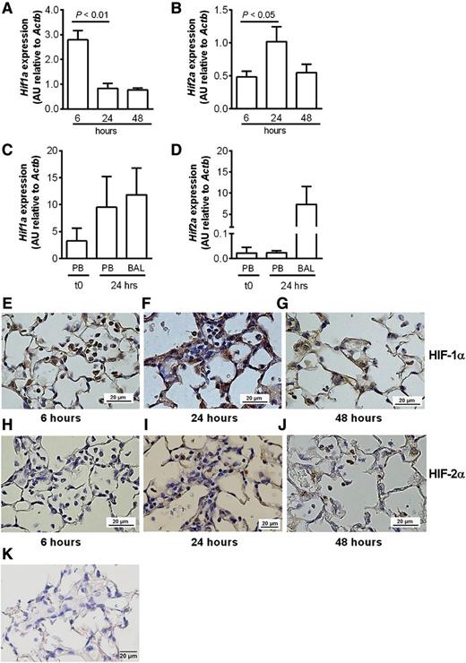 Figure 5. Differential regulation of HIF1 and HIF2 in circulating neutrophils and neutrophils recruited to the lungs following LPS-induced lung injury. (A-D) C57BL/6 mice were instilled with intratracheal LPS (0.3 µg). BAL was performed at 6, 24, and 48 hours. (A) Hif1a and (B) Hif2a expression in BAL cell lysates from C57BL/6 mice determined by Taqman and normalized to Actb. (C) Hif1a and (D) Hif2a expression in freshly isolated (t0) peripheral blood neutrophils (PBs), or peripheral blood neutrophils and BAL cells isolated 24 hours after LPS instillation. Data are mean and SEM for n = 3. (E-J) Immunohistochemistry showing expression of (E-G) HIF-1α and (H-J) HIF-2α in neutrophils of WT mice (E,H) 6, (F,I) 24, and (G,J) 48 hours following challenge with nebulized LPS (3 mg). (K) Immunohistochemistry showing no HIF-2α expression in myeloid-specific HIF-2α–deficient mouse lungs. Original magnification ×400. Images were taken using a Nikon Eclipse E600 microscope, with a Nikon DS-Ri1 camera, and processed with NIS-Elements Basic Research software (Nikon, Kingston upon Thames, United Kingdom).