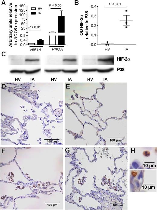 Figure 7. Expression of HIF-2α is up-regulated in neutrophils from patients with active inflammatory arthritis and is seen in neutrophils within lung biopsies from patients with COPD. (A) Expression of HIF1A and HIF2A in inflammatory arthritis patients (filled bars) and controls (open bars) was determined by TaqMan analysis of cDNA from freshly isolated peripheral blood neutrophils with data normalized to ACTB expression. Data are mean and SEM for n = 4. (B-C) HIF-2α protein expression is significantly higher in neutrophils from patients with inflammatory arthritis (IA) than healthy volunteers (HV). Freshly isolated neutrophils were lysed and proteins separated by SDS-PAGE. Blots were probed for HIF-2α, and densitometry data were normalized to p38 MAPK. (B) Data are mean and SEM for n = 3. (C) HIF-2α blots of circulating neutrophil lysates from 3 healthy volunteers (HV) and 3 patients with inflammatory arthritis (IA). (D-H) Immunohistochemistry showing HIF-2α expression in lung biopsies from a (E) nonsmoker and patients with (F) mild or (G-H) severe COPD. Images are representative of n = 2. D is a section stained with an isotype control. Original magnification: (D-G) ×200; (H) ×1000.