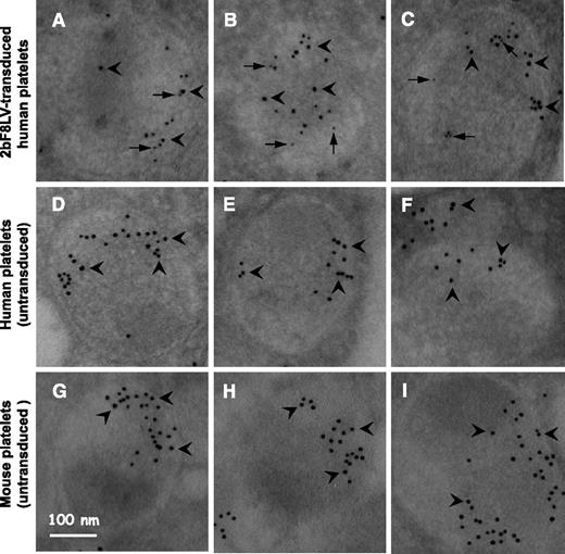 Figure 4. Electron microscopy determines cellular location of 2bF8 transgene protein. Isolated platelets from (A-C) 2bF8LV-transduced xenotransplanted NSG recipients, (D-F) normal human individuals, and (G-I) untransplanted NSG control mice were immunostained for hFVIII and either endogenous human or mouse VWF. hFVIII was stained with mouse anti-human FVIII monoclonal antibody 103.3 and probed with goat anti-mouse colloidal gold probe (6 nm; some indicated by arrows). VWF was stained with rabbit anti-human VWF polyclonal antibody (Dako), which cross-reacts with mouse VWF, and were probed with goat anti-rabbit colloidal gold probe (10 nm; some indicated by arrowheads). The results show that hFVIII is stored together with human VWF in platelet alpha-granules of 2bF8LV-transduced human platelets (A-C).