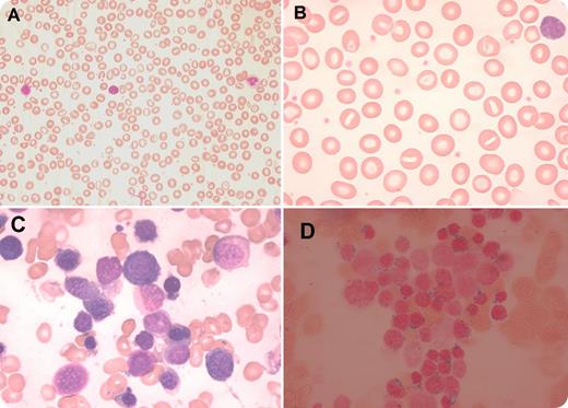 A 75-year-old woman who was previously healthy was investigated for chronic anemia. Her hemoglobin was 94 g/L with a mean corpuscular volume of 108 fL, white cell counts were normal, and platelet count was high (480 × 109/L). Blood film showed marked red cell anisocytosis with dimorphic pattern, stomatocytes, no neutrophil dysplasia, and no blasts (panel A-B). Bone marrow aspirate smear demonstrated marked hypercellularity, increased erythroid precursors with features of marked dyserythropoiesis such as megaloblastoid changes, multilobation, and nuclear budding (panel C). There was an increase in large monolobated megakaryocytes, no granulocytic dysplasia, and the blast count was 1%. Iron-stained marrow smear revealed numerous ring sideroblasts comprising 70% of erythroid precursors (panel D). The diagnosis was refractory anemia with ring sideroblasts associated with thrombocytosis (RARS-T), which is an entity of myelodysplastic/myeloproliferative neoplasm, unclassifiable according to World Health Organization classification. Bone marrow cytogenetics showed a normal karyotype and molecular test results for JAK2-V617F, JAK2-exon12, MPL-W515, and BCR-ABL mutations were negative. Ring sideroblasts are erythroid precursors that have ≥5 or more iron granules encircling one-third or more of their nuclei. RARS-T is a rare condition characterized by erythroid dysplasias, ring sideroblasts constituting 15% or more of all erythroid precursors, thrombocytosis, and atypical large megakaryocytes. Approximately 60% of patients with RARS-T demonstrate the JAK2-V617F mutation, and mutations in SF3B1 (splicing factor 3b, subunit 1) are associated with nearly 90% of cases of RARS-T.