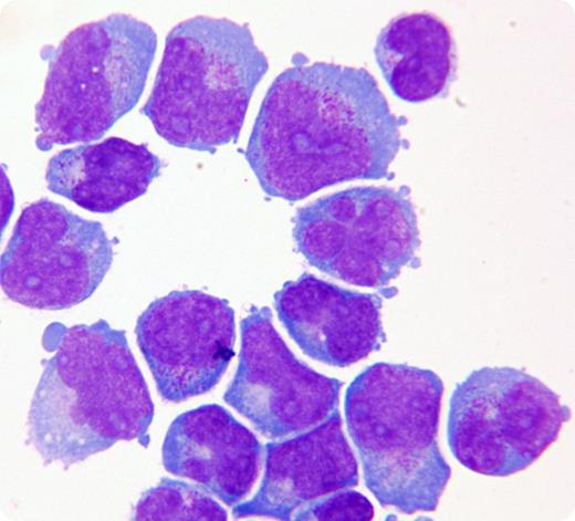 A 65-year-old woman with acute myeloid leukemia (AML), subtype acute myelomonocytic leukemia with normal karyotype in her second complete remission developed week-long severe headaches and leg weakness 3 months after completing her last chemotherapy. Computed tomography and magnetic resonance imaging revealed multiple foci of enhancement within the brain parenchyma and the leptomeninges. Lumbar puncture obtained a clear colorless fluid that was infiltrated by a large myeloblast population with cytoplasmic granules and irregularly shaped nuclei. Flow cytometry on the cerebrospinal fluid confirmed the presence of a myeloblast population expressing CD117, partial CD34, CD 13, CD33, dim CD15, dim CD4, and human leukocyte antigen–DR similar to the original myeloblast phenotype. A bone marrow aspirate and biopsy done concurrently did not show evidence of leukemic relapse, and her complete blood count was essentially unremarkable (white cell count 5.5 × 109/L, hemoglobin 130 g/L, platelets 121 × 109/L). The patient received palliative cranial radiation with progressive neurologic symptoms and succumbed to severe sepsis. / AML involving the central nervous system is rare, but it can precede systemic relapse. A normal bone marrow exam does not preclude the possibility of extramedullary disease. Prognosis is extremely poor and therapeutic options are limited to cranial radiation or intrathecal chemotherapy, usually with palliative intent.