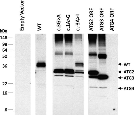 Figure 2. Western blot of RBL-1 cells transfected with ELANE vectors containing translational start-site mutations, using an antibody to the carboxyl terminus of NE. Mutations of the canonical methionine initiation codon (c.3G>A and c.1A>G) and the noncoding Kozak sequence (c.-3A>T) lead to expression of shorter isoforms of ELANE. When the upstream region is removed and only the ORF that corresponds to each ATG codon is expressed, separated isoforms are identifiable (ATG2 ORF, ATG3 ORF, and ATG 4 ORF). Molecular weight markers (in kDa; right) and NE isoforms (arrows; left) are shown.