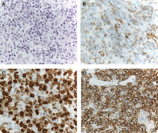 A 63-year-old female with relapsed acute myeloid leukemia (AML) after allogeneic stem cell transplantation reached CR2 after re-induction therapy followed by consolidation with donor lymphocyte infusions: 3 × 107/kg and 3 × 108/kg after 1 and 2.5 months, respectively. No signs of graft-versus-host disease were observed at this time. At 5 months follow-up, her blood count deteriorated: hemoglobin: 6.9 mmol/L, thrombocytes: 58 × 109/L and leukocytes: 1.37 × 109/L. Bone marrow aspirate was not evaluable. Bone marrow trephine biopsy showed relapse AML with hypercellularity in the H&E staining (×40 objective lens, panel A) and 20% CD34+ blast cells without any signs of maturation (panel B). Also, a high number of CD3 positive T cells (panel C) was noted, intermingling with the CD34 positive blasts, both staining positively with CD43 (panel D). Only supportive care was given. However, normalization of the blood count was observed in the following months and she developed graft-versus-host disease of the lung, which was treated with ciclosporin and prednisone. A bone marrow aspirate performed 3 months after relapse showed a third remission with 0.8% myeloid blasts. In retrospect, one could therefore consider the picture of the bone marrow trephine biopsy at the second relapse as graft-versus-leukemia in the bone marrow.