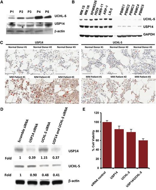 Figure 1. Characterization of 19S-associated deubiquitylating enzyme USP14 and UCHL5 in MM. (A) Purified CD138+ patient MM cells were lysed in protein lysis buffer and then subjected to immunoblotting with USP14 and UCHL5 antibodies. (B) MM cell lines and PBMCs from healthy donors were lysed in lysis buffer; lysates were then subjected to immunoblotting with USP14 and UCHL5 antibodies. Blots shown are representative of 3 independent experiments. (C) IHC analysis of bone marrow biopsies from normal donors and MM patients showing USP14 and UCHL5 expression. Scale bar = 60 µM. Red arrowheads indicate USP14 or UCHL5-positive cells (brown). (D) MM.1S cells were transfected with scramble siRNA, USP14 siRNA, UCHL5 siRNA, or USP14 plus UCHL5 siRNA by using the cell line Nucleofector Kit V. The cells were harvested 24 hours posttransfection and subjected to immunoblotting with USP14 and UCHL5 antibodies. (E) MM.1S cells were transfected with scramble siRNA, USP14 siRNA, UCHL5 siRNA, or both USP14 and UCHL5 siRNA, followed by viability analysis using a CellTiter-Glo assay. Percentage of cell viability was normalized to scramble siRNA control.