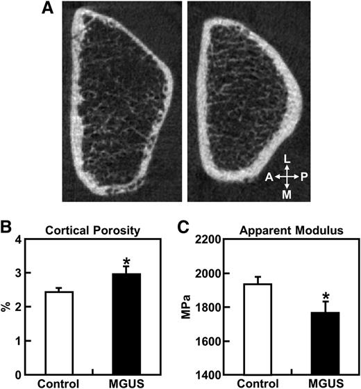 Figure 1. Radial cortical porosity and bone strength. (A) Representative cross-sectional HRpQCT images of the distal radius (slice 55 of 110) in a female MGUS patient (left panel) and an age-, gender-, and BMI-matched control subject (right panel). (B) Cortical porosity and (C) apparent modulus (bone strength corrected for cross-sectional area) at the distal radius in MGUS patients and controls. Data are shown as mean ± SE adjusted for age and gender. *P < .05 for difference between groups. A, anterior; L, lateral; M, medial; MPa, megapascal; P, posterior; SE, standard error.