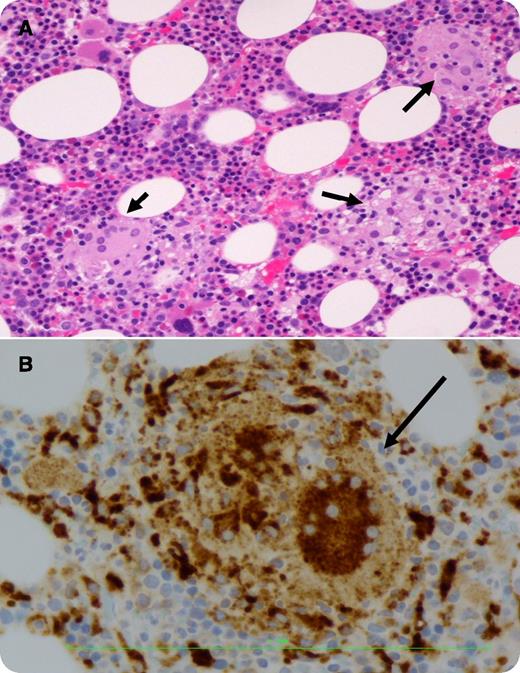 A 69-year-old nonimmunocompromised man was admitted for fever and rigors 3 weeks after traumatic catheterization during his final intravesical Bacillus Calmette–Guérin (BCG) treatment of bladder cancer. He had no symptoms following his previous 11 nontraumatic BCG treatments. He had no hepatosplenomegaly or adenopathy. He had mild thrombocytopenia of 135 × 109/L, elevated erythrocyte sedimentation rate 31 mm/h, C-reactive protein 45.6 mg/L, and the liver enzymes (alanine aminotransferase, 249 μ/L; aspartate aminotransferase, 130 μ/L; γ-glutamyltransferase, 954 μ/L; and alkaline phosphatase 385 μ/L). Cultures of blood, urine for mycobacteria, and serologic studies for Hepatitis B and Hepatitis C were negative. Bone marrow aspirate was normal but multiple small noncaseating granulomas were observed in the biopsy (panel A), CD68 highlighted the granuloma with giant cells (panel B), which was consistent with inflammatory granuloma. Silver nitrate stain, acid-fast stain, and marrow cultures were negative. A diagnosis of disseminated pauci-bacillary BCGitis and granulomatous hepatitis was suggested based on the marrow, laboratory, and clinical findings. Patient was treated with antimycobacteria therapy and prednisone with complete recovery. / There are many causes of bone marrow granuloma such as medication, sarcoidosis, and infections, including tubercle bacillus and fungi, etc. BCGitis induced inflammatory granuloma is exceptionally rare but can be observed in patients with bladder cancer following traumatic intravesical BCG treatment.
