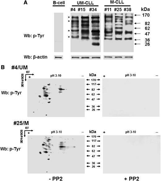 Figure 1. Lyn aberrant activity generates varying tyrosine phosphorylation patterns of the cytosolic subproteome in B-CLL cells. (A) Cytosol of freshly isolated B cells from normal donors and B-CLL patients distributed between the UM-CLL (patients 4, 15, and 34) and M-CLL (patients 11, 25, and 38) subsets was analyzed by Wb analysis with anti-pTyr antibody and probed with anti-β-actin antibody as a loading control. Asterisks indicate recurrent bands within the B-CLL samples. (B) Cytosol of freshly isolated B-CLL cells, purified from patients in different clinical stages and belonging to the unmutated (UM-CLL) and mutated (M-CLL) IgVH subsets (patients 4 and 25, respectively, in this figure) and cultured in the absence (left panels) or presence (right panels) of 10 μM PP2, was separated by 2D-PAGE using a linear wide range (pH 3-10) immobilized pH gradient in the first dimension for subsequent Wb analysis with anti-pTyr antibody. The figure is representative of samples from 6 normal donors and 24 CLL patients belonging to UM-CLL and M-CLL subsets, each of which comprised 12 samples. IEF, isoelectric focusing; SDS/PAGE, sodium dodecyl sulfate/polyacrylamide gel electrophoresis.