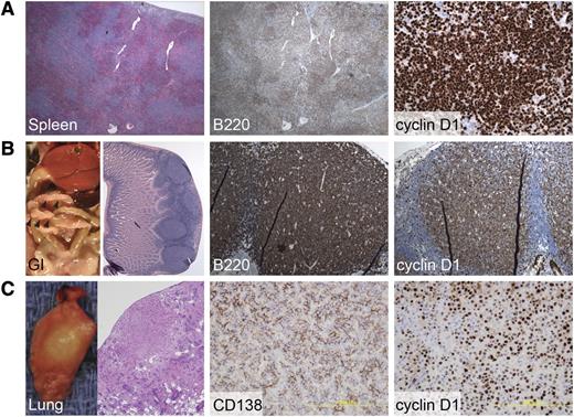 Figure 2. Rare cyclin D1–positive malignancies develop in EμCycD1CD19CREBimfl/fl mice. (A) Expanded spleen follicles that are diffusely positive for the B-cell marker B220 and for cyclin D1 were observed in an affected EμCycD1CD19CREBimfl/fl mouse. (B) Multiple gastrointestinal polyps were observed in a mouse with lymphomatoid polyposis; sheets of B220 and cyclin D1–positive B cells were evident. (C) One mouse developed lung nodules that were positive for the plasma cell marker CD138 and for cyclin D1. Original magnification (left to right): (A) ×40, ×40, ×400; (B) ×40, ×200, ×200; (C) ×40, ×400, ×400.