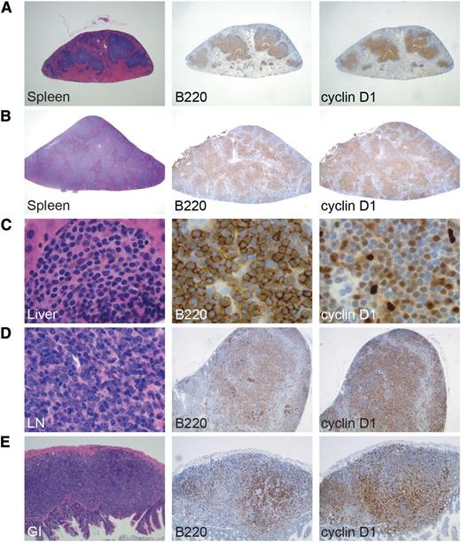 Figure 5. Development of MCL in EμCycD1CD19CREBimfl/fl mice exposed to SRBC/irradiation or weekly SRBC. Spleens from mice treated with (A) SRBC and irradiation or (B) weekly SRBC show diffuse infiltration by cyclin D1–positive B cells (original magnification: ×20). Cyclin D1–positive B cells are shown invading (C) the liver of a mouse treated with weekly SRBC injections (original magnification: ×1000), (D) the lymph node (LN) of a mouse treated with SRBC and irradiation (original magnification: ×1000, ×40, ×40), and (E) the gastrointestinal (GI) tract of a mouse treated with SRBC and irradiation (original magnification, ×100).