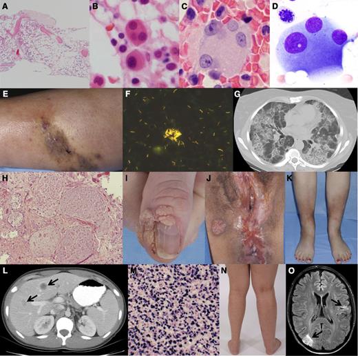 Figure 3. Clinical, pathologic, and radiographic features of GATA2 deficiency. (A) Hypocellular bone marrow with trilineage hypoplasia (36-year-old woman), bone marrow core biopsy hematoxylin and eosin stain. (B-D) Atypical megakaryocytes, small mononuclear (B), and dysplastic forms with separated nuclear lobes (B-D); taken from bone marrow core biopsies (B,C) and aspirate smear (D). (E) Cutaneous M abscessus infection and (F) skin biopsy AFB smear showing abundant mycobacteria. (G) Computed tomography scan of the chest showing the typical crazy paving pattern of PAP and (H) lung biopsy hematoxylin and eosin stain showing alveolar filling with lipoproteinaceous material. (I) Recalcitrant periungual warts, (J) perineal condyloma, and vulvar/anal intraepithelial neoplasia. (K) Panniculitis/erythema nodosum involving the anterior shins. (L) Computed tomography scan of the abdomen with multiple hypodense liver lesions (arrows) and (M) liver biopsy showing EBV-related spindle cell tumor with in situ hybridization of EBV-encoded messenger RNA using EBV probe antifluorescein antibody and bond polymer refine detection. (N) Unilateral lymphedema of the right lower extremity. (O) Magnetic resonance imaging of the brain with embolic infarcts in the right occipital and left parietal lobes (arrows) in the setting of culture-negative endocarditis.