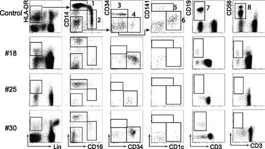 Figure 1. Mononuclear cell profiles of patients with Emberger syndrome, monoMAC, and familial MDS associated with GATA2 mutation. Examples of mononuclear profiling in familial MDS (#18; T354M), monoMAC (#25; del340-381), and Emberger syndrome (#30; A341fs) showing that a DCML-deficiency phenotype may be associated with diverse clinical manifestations and different GATA2 mutations. Populations: (1) CD14+ monocyte; (2) CD16+ monocyte; (3) pDC; (4) CD34+ progenitors; (5) CD141+ mDC; (6) CD1c+ mDC; (7) B cells; and (8) NK cells. Note expansion of CD34+ progenitors.