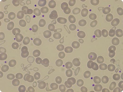A 42-year-old woman was referred to hematology for a mild chronic nonregenerative microcytic anemia discovered 18 years before. The physical examination was normal. The hemoglobin level was 9.6 g/dL, with a mean corpuscular volume at 73 fL and mean hemoglobin content at 23 pg; the red cell distribution width value was high (27%). The leukocyte and platelet counts were normal. The plasma ferritin level was increased (465 µg/L). Magnetic resonance imaging confirmed significant iron overload in the liver, estimated at 340 µmol/g. No common mutation of the HFE gene was found, excluding iron liver overload attributable to a genetic primary hemochromatosis. Smear examination showed striking poikilocytosis with presence of a double population of erythrocytes, one normal and the other extremely microcytic and hypochromic. In the bone marrow aspirate, 35% of erythroid cells were ring sideroblasts. / DNA sequencing of the ALAS2 gene confirmed the diagnosis of X-linked sideroblastic anemia, detecting the heterozygous mutation c.787G>A (Asp263Asn). The HUMARA assay of blood leukocytes revealed a skewed X-chromosome inactivation ratio of 90:10, explaining the hematologic phenotype. Oral pyridoxine therapy increased the level of hemoglobin up to 11.4 g/dL, and peripheral blood smears showed disappearance of the microcytic population.