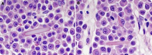 A 68-year-old man presented with pain and malaise. Laboratory studies showed pancytopenia, hypercalcemia, increased creatinine, and proteinuria. Serum protein electrophoresis revealed an M-spike (0.2 g/dL) and immunofixation confirmed λ-light chain. Bone marrow showed sheets of λ-light chain restricted plasma cells with readily identifiable extracellular hexagonal crystals on aspirate and biopsy (panel A), and occasional intracellular crystals in plasma cells on biopsy (panel B). The crystals were eosinophilic by hematoxylin and eosin stain. They failed to stain for Wright-Giemsa or κ-/λ-light chains. No giant cell reaction was observed. / Russell and Dutcher bodies are cytoplasmic and pseudonuclear globular immunoglobulin inclusions and can be seen in plasma cell myeloma (PCM). Extracellular and intracellular crystal deposition, however, is a rare but documented finding in PCM. Indirect immunoperoxidase method reportedly disclosed their immunoglobulin nature. Lack of immunostain for light chains has been a consistent finding and likely attributable to the crystalline conformation. Electron microscopy demonstrated crystalline structures surrounded by smooth membrane. Associated M-protein can be κ- or λ-light chains or full immunoglobulin, most commonly immunoglobulin G. Giant cell reactions are rare. Crystal deposition at other sites such as joint, kidney, and skin has been reported in PCM. The prognostic significance of crystal deposition in PCM has not been clearly documented.