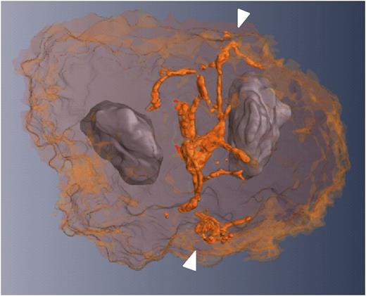 Focused ion beam-scanning electron microscopy 3D reconstruction of the predemarcation membrane system (orange) located between the 2 lobes of the nucleus (gray) of an immature megakaryocyte. The white arrows point to the inner membrane system. See Figure 2 in the article by Eckly et al that begins on page 921.