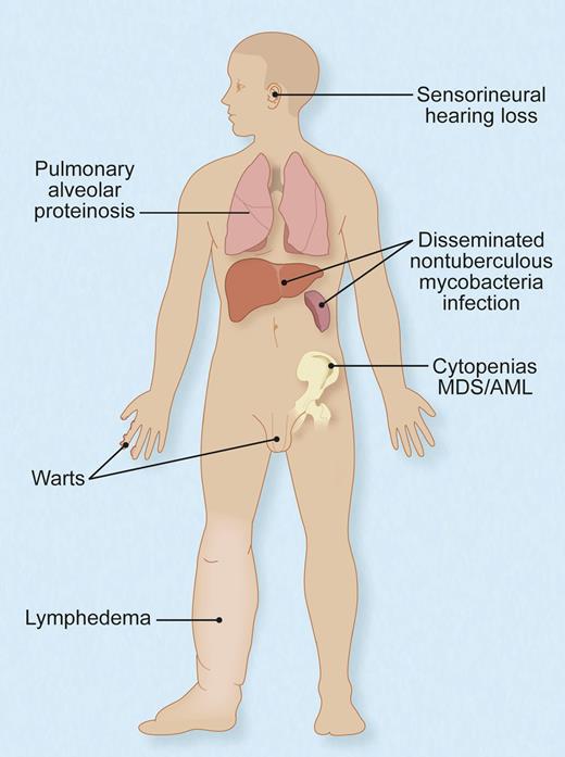 Protean manifestations of germ-line, heterozygous mutations of GATA2. Not all individuals have all, or even any, of these features, and their timing and sequence of occurrence and complementation by hematopoietic stem cell transplant are not fully understood. Adapted with permission from Figure 6 in the article by Spinner et al.1 Professional illustration by Debra T. Dartez.