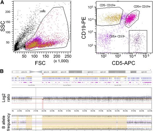 Figure 1. Analysis of an AGS patient. (A) Flow cytometry plot from whole peripheral blood of an AGS patient showing (left) forward-sideward scatter and (right) CD19 PE/CD5 APC scatter gated on lymphoid cells. (B) Whole genome array of chromosome 20 from leukemia cells of an AGS patient, visualized in Nexus (BioDiscovery). The log2 ratio indicates copy number changes, and the B-allele frequency plot indicates loss of heterozygosity.