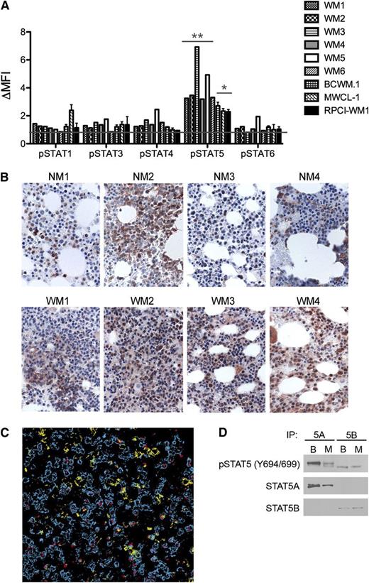 Figure 1. Activation of STAT5 in malignant WM B cells. (A) Baseline STAT phosphorylation was measured in freshly sorted CD19+CD138+ cells obtained from the bone marrows of patients with WM (n = 6) and MWCL-1, BCWM.1, and RPCI-WM1 cells. After fixation and permeabilization, tyrosine phosphorylation of STATs 1, 3, 4, 5, and 6 was determined via fluorescence-activated cell sorter analysis. Normalization for nonspecific antibody binding was performed by dividing the mean fluorescence intensity associated with the specific phospho-antibody signal by the mean fluorescence intensity (MFI) of the isotype control. Data are presented as the normalized MFI (ΔMFI). Significance of STAT5 phosphorylation relative to other STAT proteins was determined by the Student t test for both primary cells and WM cell lines. *P < .05; **P < .01. (B) Immunohistochemical staining of pSTAT5 (brown) in bone marrow sections obtained from 4 consenting patients with WM (WM1-WM4) and 4 normal bone marrows (NM1-NM4) was performed using a polyclonal anti-pSTAT5 antibody, as described in “Methods.” Slides were visualized on an Olympus Provus AX70 light microscope, and images shown are original magnification ×400. (C) Costaining of pSTAT5 (red) with CD20+-expressing (blue) and CD138+-expressing (yellow) B cells in WM bone marrow. (D) Immunoprecipitation for STAT5A (5A) and STAT5B (5B) was performed on unstimulated BCWM.1 (column B) and MWCL-1 (column M) cells followed by western blotting and detection of STAT5A, STAT5B, and pSTAT5.