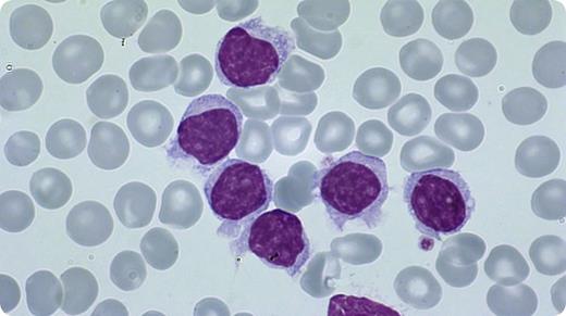 An 81-year-old man was evaluated for a leucocytosis (76 G/L) with 90% atypical lymphocytes and mild thrombocytopenia (130 G/L). The atypical lymphocytes were large, with round or oval nuclei, condensed chromatin, often a prominent nucleolus, and a blue-grayish cytoplasm with scattered hairy projections, often resembling prolymphocytes. By flow cytometry, hairy cell leukemia-variant (HCL-v) was diagnosed (CD19+/CD11c+/CD103+/CD25−). According to the World Health Organization 2008 classification, HCL-v has to be distinguished from 2 other B-cell neoplasms, which may present as hairy leukemias: HCL and splenic marginal zone lymphoma (SMZL). The distinction between HCL and HCL-v is clinically important, because HCL-v responds poorly to nucleosid analogues, which is the standard treatment for HCL. / HCL typically features a pancytopenia (particularly monocytopenia), whereas HCL-v usually shows a considerable leucocytosis, with many prolymphocytic elements, which are rare in HCL. A dry tap is typical for HCL due to marrow fibrosis, but aspiration is usually possible in HCL-v. The flow cytometric detection of 4 antigens (CD11c/CD25/CD103/CD123) allows the correct diagnosis: HCL and HCL-v are positive for CD11c, CD103, and CD123, whereas CD103 and CD123 are negative in SMZL. CD25 is positive in HCL and negative in HCL-v. The BRAF-V600E mutation, typical for HCL, is not found in HCL-v.
