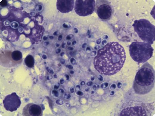 A 48-year-old male with history of alcohol abuse and untreated HIV presented with 1-week history of fever, abdominal pain, and diarrhea. Complete blood counts showed pancytopenia with hemoglobin of 71 g/L, total leukocyte count of 2.2 × 109/L, and platelet count of 92 × 109/L. Initial renal, liver, and coagulation studies were normal. CD4 count was 23/µL, and HIV viral load was 3 600 000/mL. Hepatitis serology, stool studies, blood, urine, and sputum cultures were negative. Peripheral blood smear demonstrated no intracellular organisms. Serum lactate dehydrogenase and blood and urine for Histoplasma antigen were not checked. Computed tomography of the abdomen and pelvis showed no evidence of lymphadenopathy or hepatosplenomegaly. Over the following 2 weeks, he developed a rapidly progressive multiorgan failure manifested by liver failure with coagulopathy, acute renal failure necessitating hemodialysis support, and respiratory failure requiring mechanical ventilation. / Bone marrow studies showed numerous histiocytes with intracellular fungal organisms morphologically consistent with histoplasmosis. He was promptly started on amphotericin B. Timely diagnosis of disseminated histoplasmosis requires a high index of clinical suspicion owing to the high mortality associated with it. Bone marrow studies may aid in the diagnosis and should be considered in the appropriate clinical scenario.