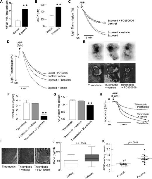 Figure 6. Increased calpain activity after hypoxia exposure in rats and human DVT patients, and the antithrombotic effect of calpain inhibition in vivo and ex vivo. Platelets were isolated from indicated groups and processed for either florescence-based calpain activity or intracellular calcium assays, as described in the supplemental Methods. (A) Quantitation of calpain activity in platelets demonstrating higher proteolytic activity of calpain in exposed animals. (B) Intraplatelet calcium levels measured by Fura-2 based fluorogenic assay showed increased platelet iCa2+ in exposed animals. (C-D) Representative aggregation curves showing reversal of hypoxia-induced platelet aggregation by preincubation of PRP with calpain inhibitor PD150606 (50 µM) ex vivo (C) and by preinfusion of PD150606 (1 mg/kg body weight) in vivo (D). (E-I) The antithrombotic and platelet inhibitory effects of preinfusion of PD150606 via tail vein in rat model of stasis-induced thrombosis, as described in the supplemental Methods. (E) Representative images of extracted portions of IVC with thrombus (top) from thrombotic animals with their heat maps (bottom), showing smaller thrombus in the case of PD150606 preinfusion. (F) Quantitations of the size of the thrombus isolated from the IVC portions of thrombotic animals (n = 8). (G) Decreased calpain activity in platelets isolated from thrombotic animals preinfused with PD150606. (H) Representative platelet aggregation curves showing a strong negative effect of PD150606 preinfusion in thrombotic rats compared with vehicle control or no infusion. Data are presented as mean ± SEM (n = 8) and analyzed by unpaired t test. *P < .05, **P < .01 vs thrombotic + vehicle. (I) Hematoxylin-eosin-stained sections of thrombus with vessel wall, showing morphological differences (×200 original magnification). (J-K) The plasma samples from human DVT patients from high-altitude regions and from control individuals were analyzed for soluble P selectin levels and calpain activity, (J) Higher sP-selectin levels in plasma samples (data presented as box and whiskers plot) indicated hyperactive platelets in high-altitude-induced DVT patients. (K) Calpain activity in human plasma samples of high-altitude-induced DVT patients compared with age- and sex-matched healthy controls, shown as a scatter plot (n = 10). The activity in patients was significantly (P = .0014) higher in comparison with controls. Data are presented as mean ± SEM (n = 10 in each group) and analyzed by t-test compared with respective controls.