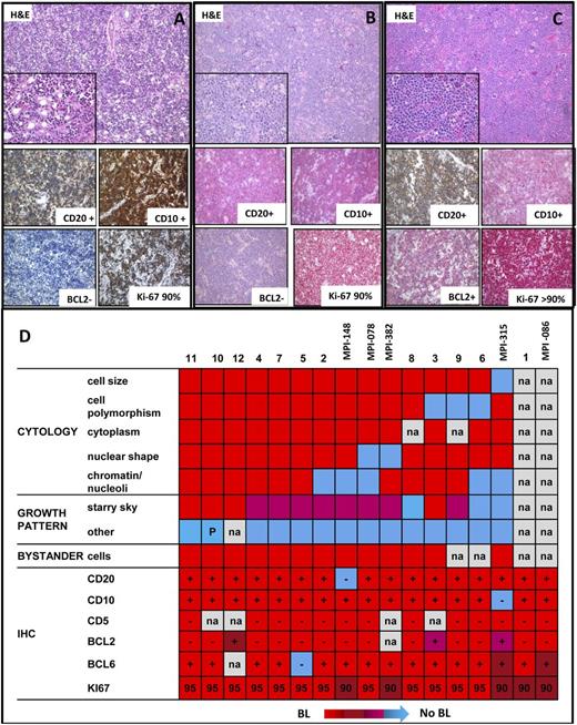 Figure 3. Morphologic features of MYC-negative high-grade lymphomas. (A) Hematoxylin and eosin preparation showing the morphology and CD20, CD10, BCL2, and Ki67 expression by immunohistochemistry of (A) case 1, (B) case 2, and (C) case 3 in cohort 2. (D) Heatmap showing the morphologic and the immunohistochemical features of the 17 MYC-negative high-grade lymphomas. The morphologic characteristics included information of the cytology, growth pattern, and bystander cells. Red, pro-Burkitt: medium cell size; no cell polymorphism; narrow cytoplasm; round nuclear shape; multiple, small, and paracentric nucleoli; “starry-sky” growth pattern; scattered bystander cells; and sparse eosinophils. Blue, no BL-like: large cell size; cell polymorphism; abundant cytoplasm; irregular nuclear shape; multiple, small, eccentric (centroblast-like) nucleoli/single, large, central (immunoblast-like) nucleolus/finely, granular (lymphoblast-like)/other chromatin; absent “starry-sky” growth pattern; abundant bystander cells. Immunohistochemical analyses included data on CD20, CD10, CD5, BCL2, BCL6, and Ki67. –, negative; +, positive; IHC, immunohistochemistry; na, not available; P, partial.
