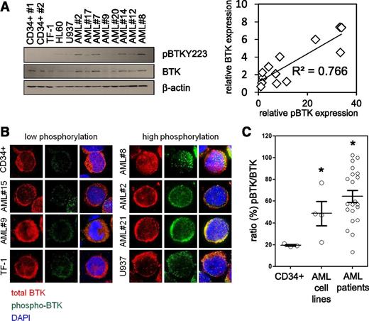 Figure 1. BTK is highly expressed and constitutively phosphorylated in AML. (A) Control CD34+ cells, AML patient cells, and AML cell lines measured for constitutive levels of BTK phosphorylation by western blotting analysis, blots re-probed for wild-type BTK and β-actin to show BTK expression, and sample loading, respectively. Correlation analysis of p-BTK/BTK expression using densitometry is shown. (B) Primary CD34+ cells, AML cells, and AML cell lines were analyzed for phosphorylated BTK (Y223) (green) and total BTK (red) by immunocytochemistry. 4′,6-diamidino-2-phenylindole nuclear stain is shown in blue. (C) Using the immunocytochemical images captured, p-BTK was calculated as a percentage of total BTK. Values indicate the mean ± standard error of the mean from at least 5 individual experiments, sampling at least 10 representative cells from each view. *Statistical significance of P < .05 between the different treatment groups using Student t test.