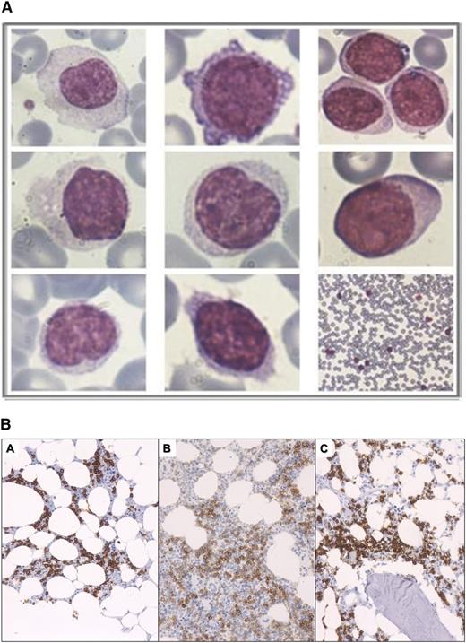 Figure 1. Peripheral blood cytology and BM pathology. (A) Peripheral blood smear lymphocyte cytology. Morphologic heterogeneity of the lymphocytic population was apparent in most CBL-MZ cases. (B) Patterns of BM lymphocytic infiltration by predominately small B-lymphocytes showing interstitial with minor extent of intrasinusoidal pattern of infiltration (A), interstitial pattern of infiltration (B), and paratrabecular and interstitial pattern of infiltration (C). In all images, B cells are depicted with the CD20 antibody.