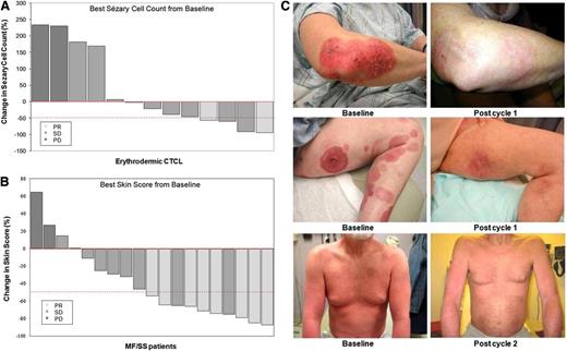 Figure 1. Clinical responses. Maximum percent improvements from baseline in (A) circulating Sézary cell counts (in 13 patients with erythrodermic CTCL and Sézary cell counts at baseline) and in (B) skin scores (in 19 patients with MFs/Sézary Syndrome). Partial responders (PR) are depicted by light gray bars, SD by medium gray bars, and PD by dark gray bars. The dashed line at −50% represents the threshold for PR. (C) Clinical presentations of patients with plaques (stage IB), tumors/plaques (stage IIB), and erythrodermic MFs (stage IVA) before and during treatment with near-complete clearance of plaques, tumors, and erythroderma.