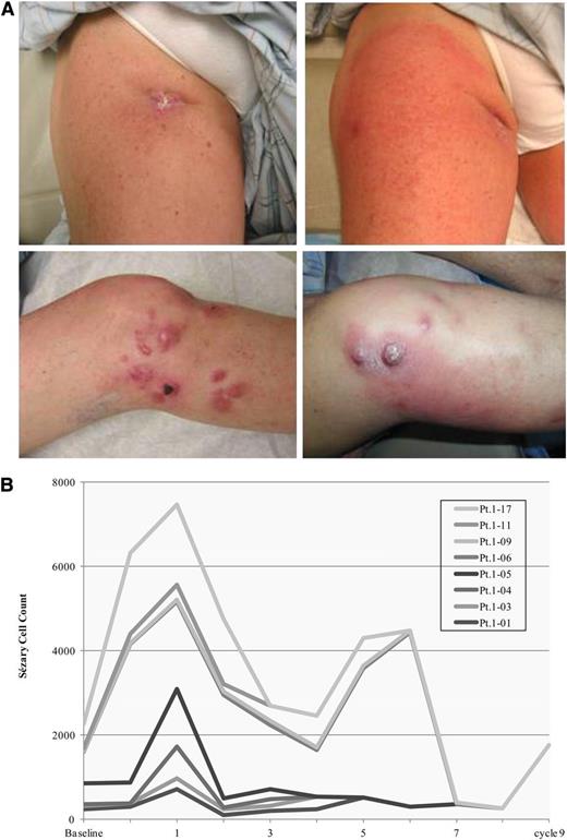 Figure 2. Tumor flare reaction. (A) Documented tumor flare reactions presenting as erythema around lymph node and cutaneous tumor lesions in a patient with tumor-stage MFs. (B) Increasing Sézary cell counts in patients with or without Sézary cell counts at baseline that eventually decreased or resolved with continued treatment. Pt., patient.