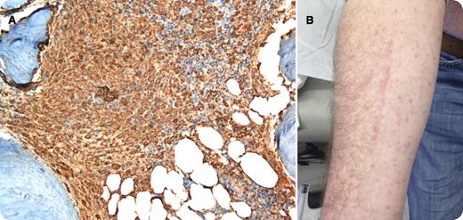 A 39-year-old man with a 10-year history of pruritus, chronic watery diarrhea, and diffuse, hyperpigmented skin papules underwent skin biopsy, which showed numerous superficial mast cells by CD117+ immunohistochemistry. A serum tryptase level was 417 ng/mL (reference range, 2-10 ng/mL), and referral was made to Hematology. Bone marrow biopsy revealed abundant aggregates of mast cells (panel A, CD117+), and random colonic biopsies revealed subepithelial sheets and aggregates of mast cells. The diagnosis of systemic mastocytosis was made. Histamine receptor blockade with cetirizine and ranitidine provided symptomatic relief, as did the mast cell–stabilizing agents cromolyn and monteleukast. / Six months later, this patient demonstrated clinical improvement but extensive urticaria pigmentosa (UP) lesions persist on the trunk and extremities. Darier's sign remains positive, wherein gentle friction is sufficient to degranulate mast cells associated with the UP lesions (panel B, after the examiner traced a vertical line on the patient’s forearm). Unlike other forms of dermatographism, Darier’s sign refers to urtication that is limited to the UP involved areas and, as in this case, spares the skin unaffected by UP.