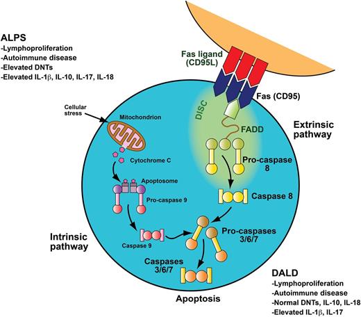 To downregulate the immune system after systemic insult, activated B and T lymphocytes upregulate Fas, and activated T lymphocytes upregulate Fas ligand. These two interact through the Fas-activating death domain (FADD) to trigger the caspase cascade, leading to cellular apoptosis. Apoptosis mediated through the FAS death receptor is part of the extrinsic apoptotic pathway. In contrast, apoptosis initiated in the mitochondria is part of the intrinsic apoptotic pathway. Patients with ALPS and DALD have a defect in the FAS apoptotic pathway. ALPS and DALD patients develop lymphoproliferation and autoimmune disease. ALPS patients have elevated peripheral blood DNTs, a hallmark of the disease, whereas DALD patients do not. Patients with ALPS typically have elevated serum levels of IL-10 and IL-18. Boggio et al demonstrate that DALD patients do not have elevated IL-10 or IL-18 levels. They also make the novel observations that both ALPS and DALD patients have elevated IL-17A and IL-17F levels as well as elevated IL-1β levels, providing a number of potential therapeutic targets for future investigations. Adapted with permission from a professional illustration by Sue Seif.