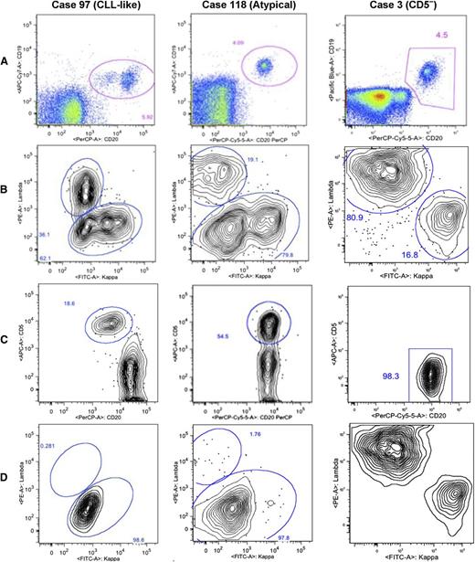 Figure 1. Gating strategy used for the detection of 3 distinct immunophenotypes of MBL. Representative immunophenotypes are shown for the 3 categories: CLL-like (CD19+CD5+CD20dim), atypical (CD19+CD5+CD20bright), and CD5ˉ (CD19+CD5ˉ) MBL.16,17 (A) Two parameter histograms of CD20 peridinin chlorophyll protein complex (PerCP) on x-axis and CD19 (allophycocyanin Cy7 or Pacific Blue) on y-axis were based on initial CD45 expression and SSC signal. B cells are gated for subsequent analysis. (B) κ (FITC) λ (PE) analysis on gated B cells. Cases 97 and 118 have bimodal κ populations showing dim clone and bright polyclonal κ cells. Case 3 shows 80.9% λ population. (C) Gated B cells are displayed on a CD20 vs CD5 plot. Case 97 is subgated on CD20dim and CD5+,bright B cells. Case 118 is subgated on CD5+ B cells. In case 3, all the B cells are CD5ˉ. (D) Subgated B cells from panel C are displayed on a κ vs λ plot. Case 97 shows 98.6% κ+ clone on κ-λ analysis on gated CD20dim/CD5+ B cells. Case 118 shows κ-λ analysis on gated CD5+ B cells showing 97.8% κ+ clone. Case 3 shows a skewed κ-λ analysis on gated CD5ˉ B cells showing 81.9% λ+ cells. FITC, fluorescein isothiocyanate; PE, phycoerythrin.