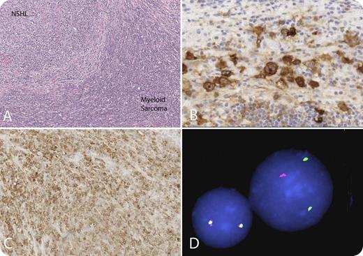 A 19-year-old man with nodular sclerosis Hodgkin lymphoma, diagnosed on mediastinal mass biopsy, was in remission after completing 12 weeks of Stanford V chemotherapy, which includes adriamycin, vincristine, nitrogen mustard, bleomycin, etoposide, and prednisone, followed by radiation to the mediastinum. Two years after diagnosis, the patient was found to have a mediastinal mass and surrounding enlarged lymph nodes. A biopsy demonstrated recurrent Hodgkin lymphoma (panels A-B) and a mononuclear cell infiltrate forming sheets and dissecting between collagen bundles, which immunophenotyped as myeloblasts (panels A-C). Mixed lineage leukemia (MLL) fluorescence in situ hybridization on the paraffin-embedded tissue from the mediastinal mass revealed an MLL rearrangement (panel D). A bone marrow aspirate and biopsy were performed and showed no morphologic evidence of acute myeloid leukemia (AML) or cytogenetic abnormalities, but reverse transcription-polymerase chain reaction for MLL breakpoints t(9;11) was positive in less than 1% of cells. This is an interesting case of nodular sclerosis Hodgkin lymphoma that relapsed after 2 years with concomitant myeloid sarcoma in the same biopsy. Therapy-related AML (TR-AML) with balanced translocations, as seen here t(9;11), is associated with topoisomerase II inhibitors (etoposide) and a short latency period and presents with AML without a preceding myelodysplastic phase, as was the case in this patient. / Although TR-myelodysplastic syndrome/AML has been described in Hodgkin lymphoma, concomitant therapy-related myeloid sarcoma in the same site as recurrence has not been described. Although TR-myelodysplastic syndrome/AML has an overall poor prognosis, the prognosis of a myeloid sarcoma with minimal involvement of the marrow is unclear. At relapse, the patient was treated with 2 cycles of clofarabine, cyclophosphamide, etoposide, and dexamethasone and received a bone marrow transplant. / (A) Hematoxylin and eosin (nodules separated by bands of fibrosis). In the nodules are classic Reed-Sternberg cells. The mononuclear cells forming sheets are the myeloid blasts. (B) CD30 highlights the Reed-Sternberg cells. (C) Myeloperoxidase highlights the myeloid blasts. (D) MLL split apart probe. The yellow signal is normal because they are fused; the red and green signals are separated because there is an MLL rearrangement. Panel D courtesy of Dr Susana Raimondi, St. Jude Children's Research Hospital.