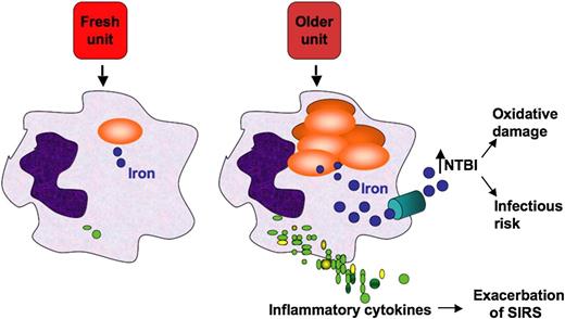 Proposed mechanistic pathway (the “iron hypothesis”) explaining how transfusion of older stored RBCs may induce adverse effects in patients. Transfusion of stored, but not fresh, RBCs delivers an acute bolus of RBCs and RBC-derived iron to the monocyte/macrophage system, resulting in oxidative stress and inflammatory cytokine secretion. Some of the macrophage-ingested iron is also released back into the circulation (ie, NTBI), where it can also cause oxidative damage and enhance bacterial proliferation. SIRS, systemic inflammatory response syndrome. Reprinted from Hod et al6 with permission.